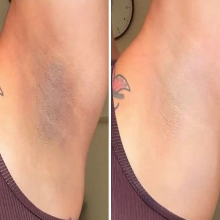 Gel Exfoliante Aclarante